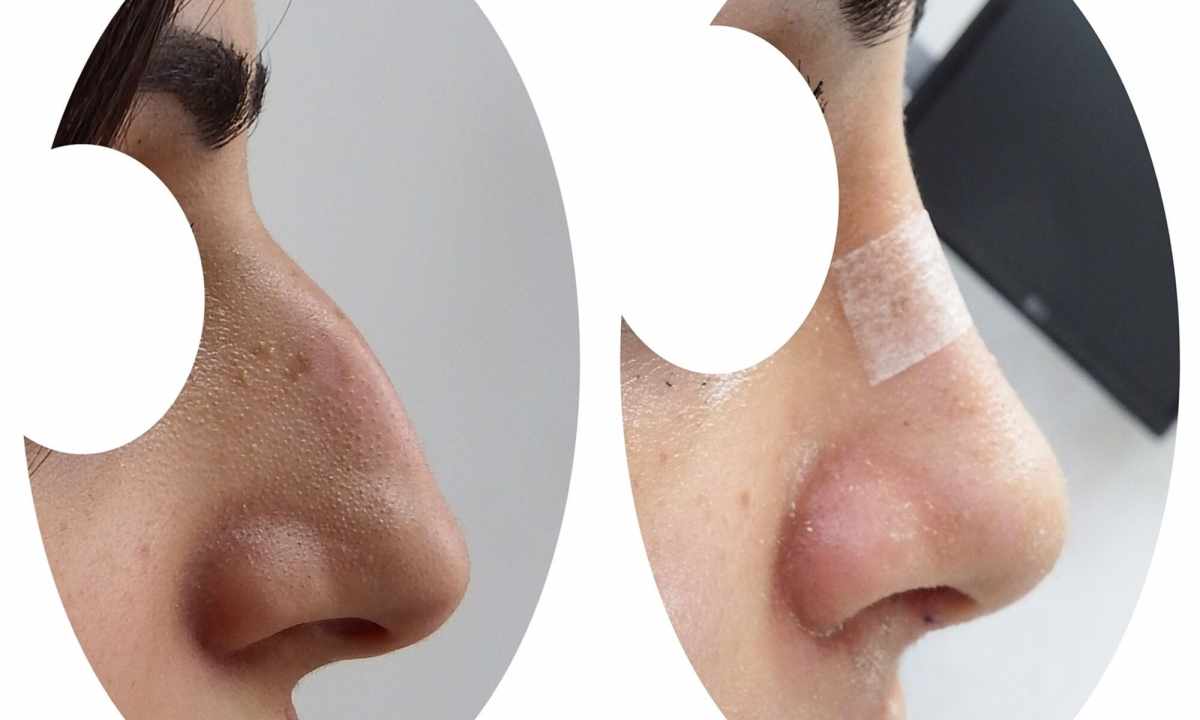 How to correct shape of nose
