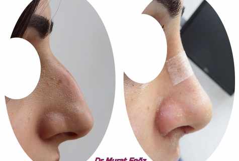How to correct shape of nose