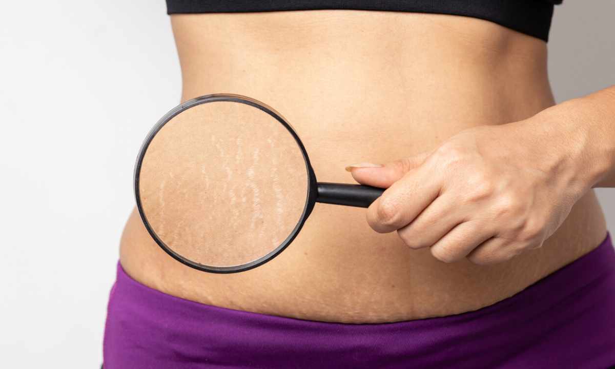 How to get rid of extensions on stomach after the delivery
