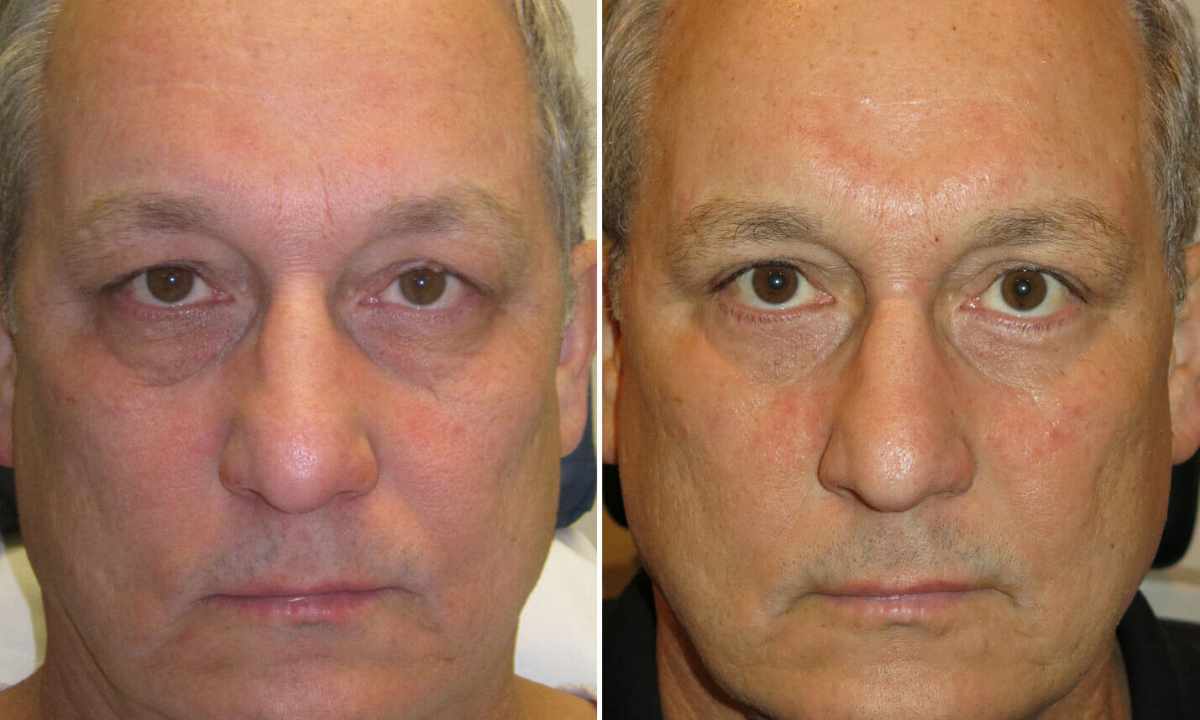 Blefaroplastik. What does the plastics of upper and lower eyelid threaten with?