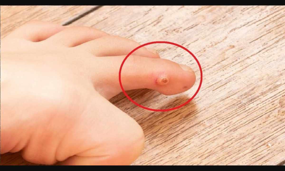 How to get rid of bottom warts