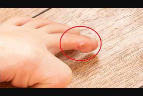 How to get rid of bottom warts