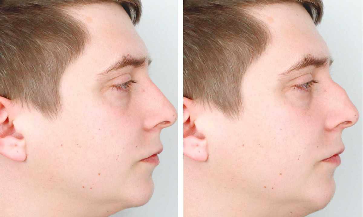 If the nose tip form does not arrange. Rhinoplasty - pros and cons