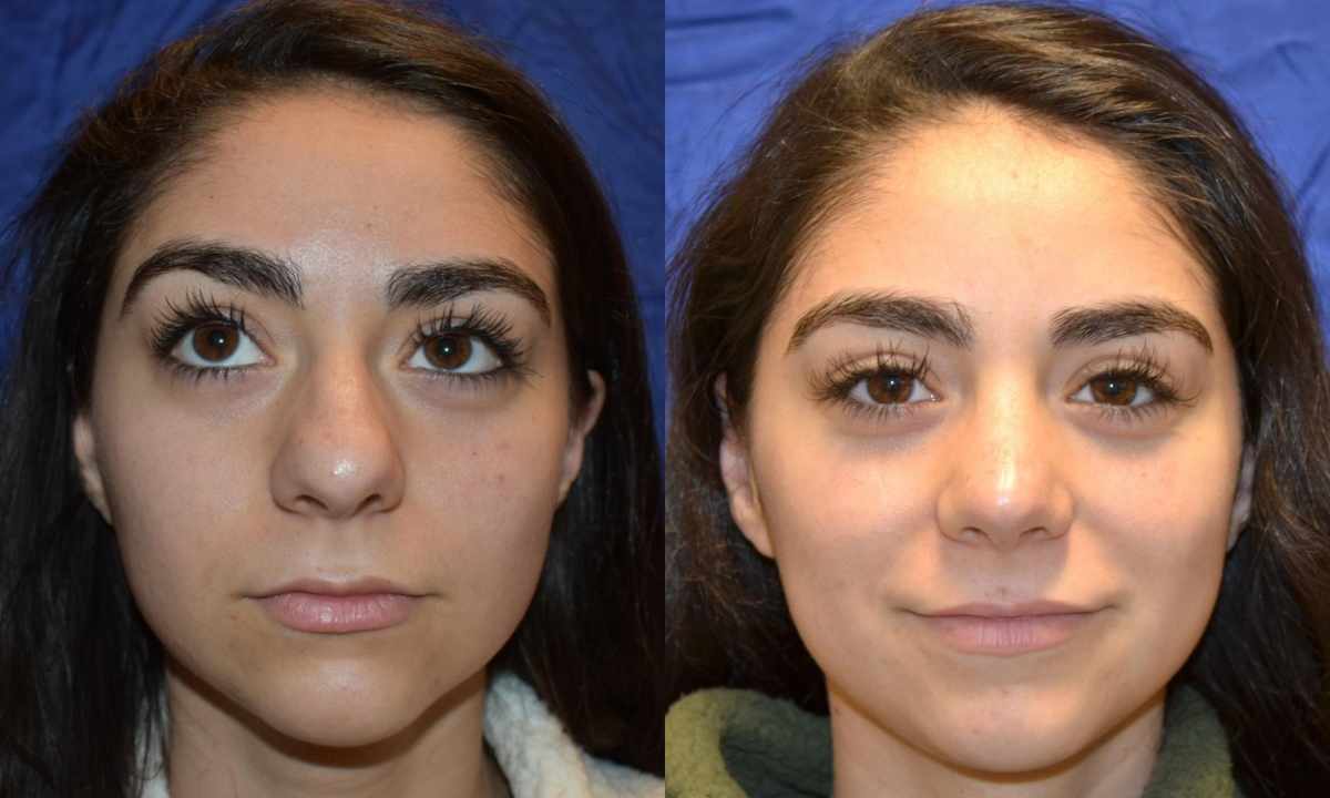 How to fix nose without operation