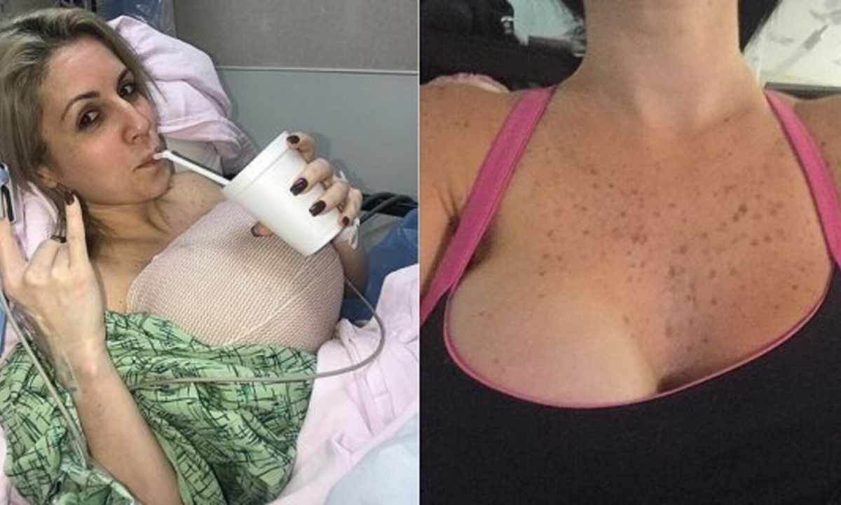 Disposal of extensions on breast