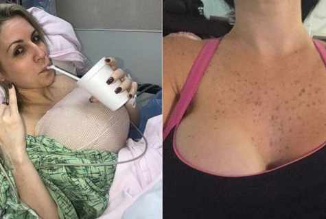Disposal of extensions on breast