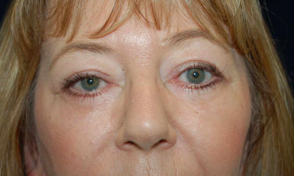 Blefaroplastik of upper and lower eyelids