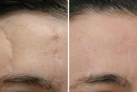 As without laser to remove scars