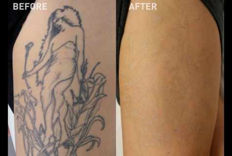 Removal of tattoo laser: before and after