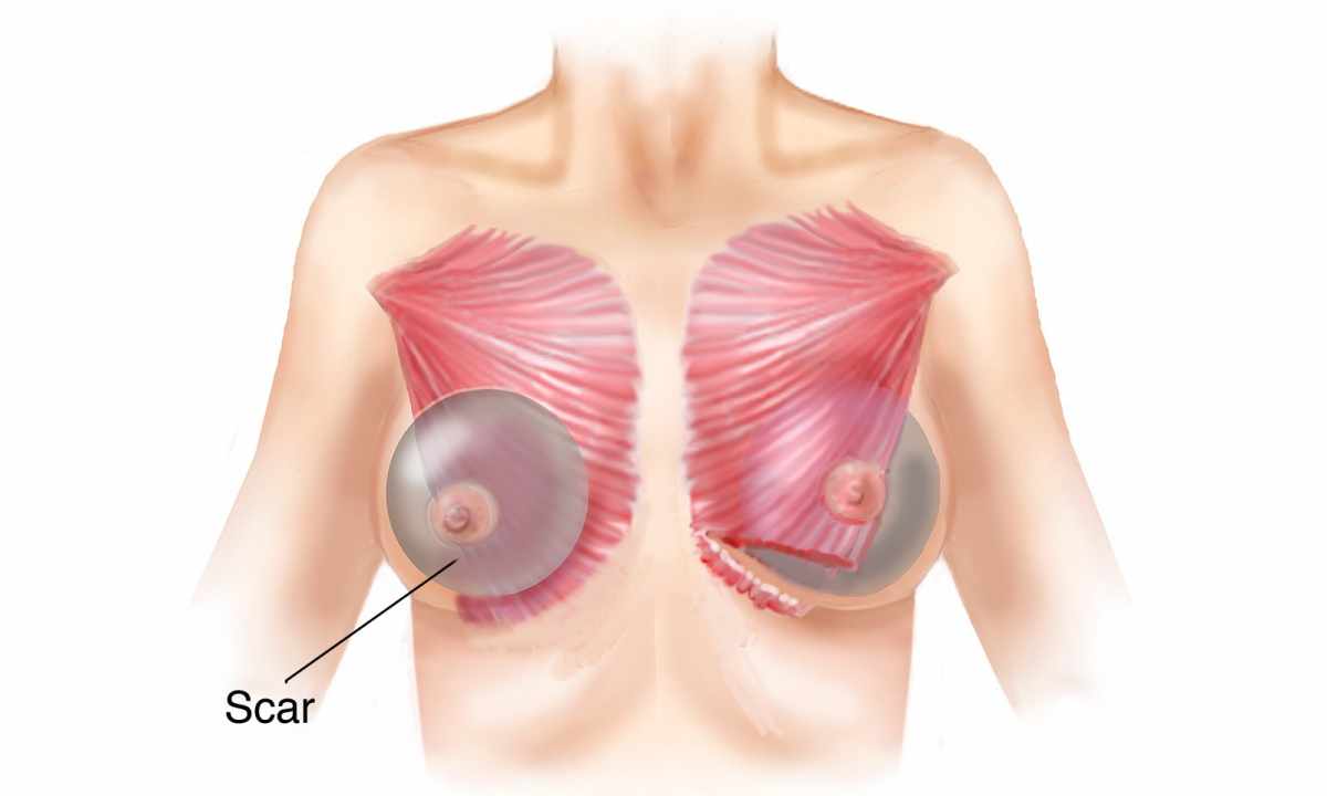 How to tighten breast muscles