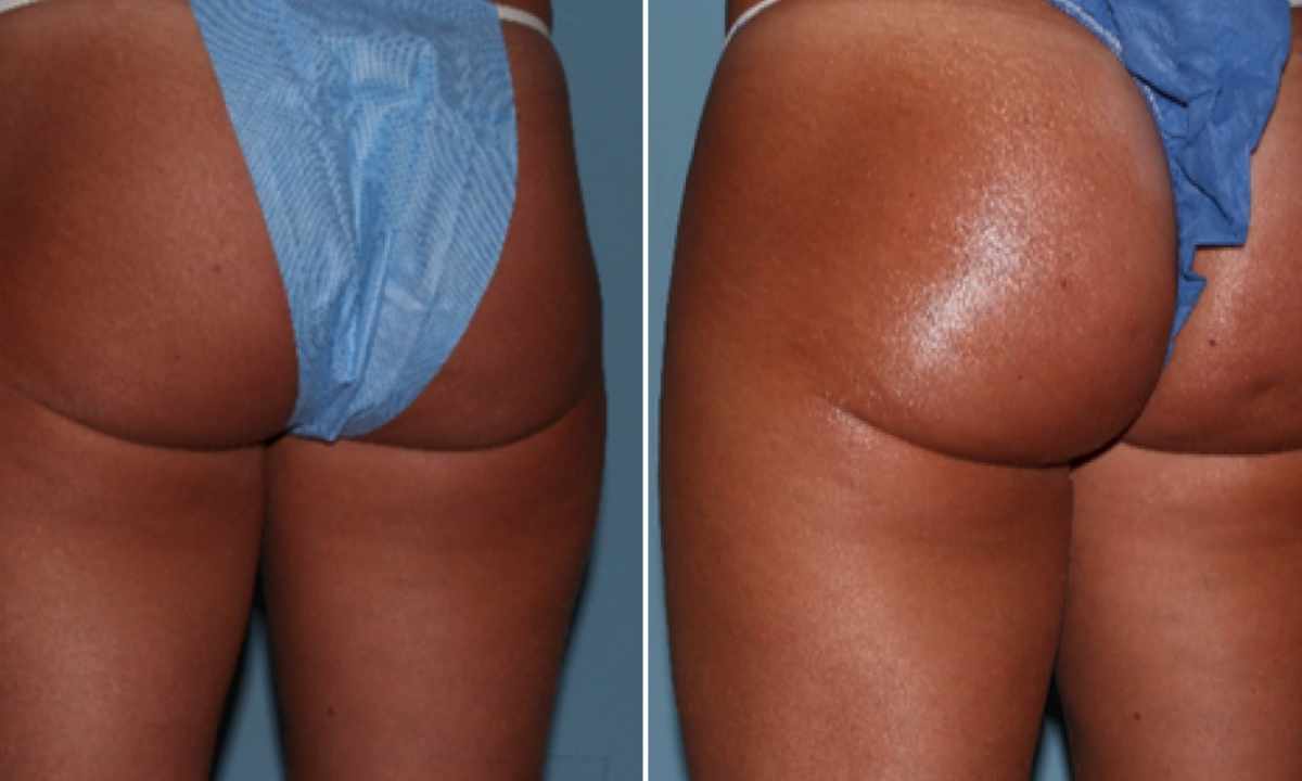 How to remove excess weight on buttocks