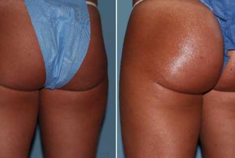 How to remove excess weight on buttocks