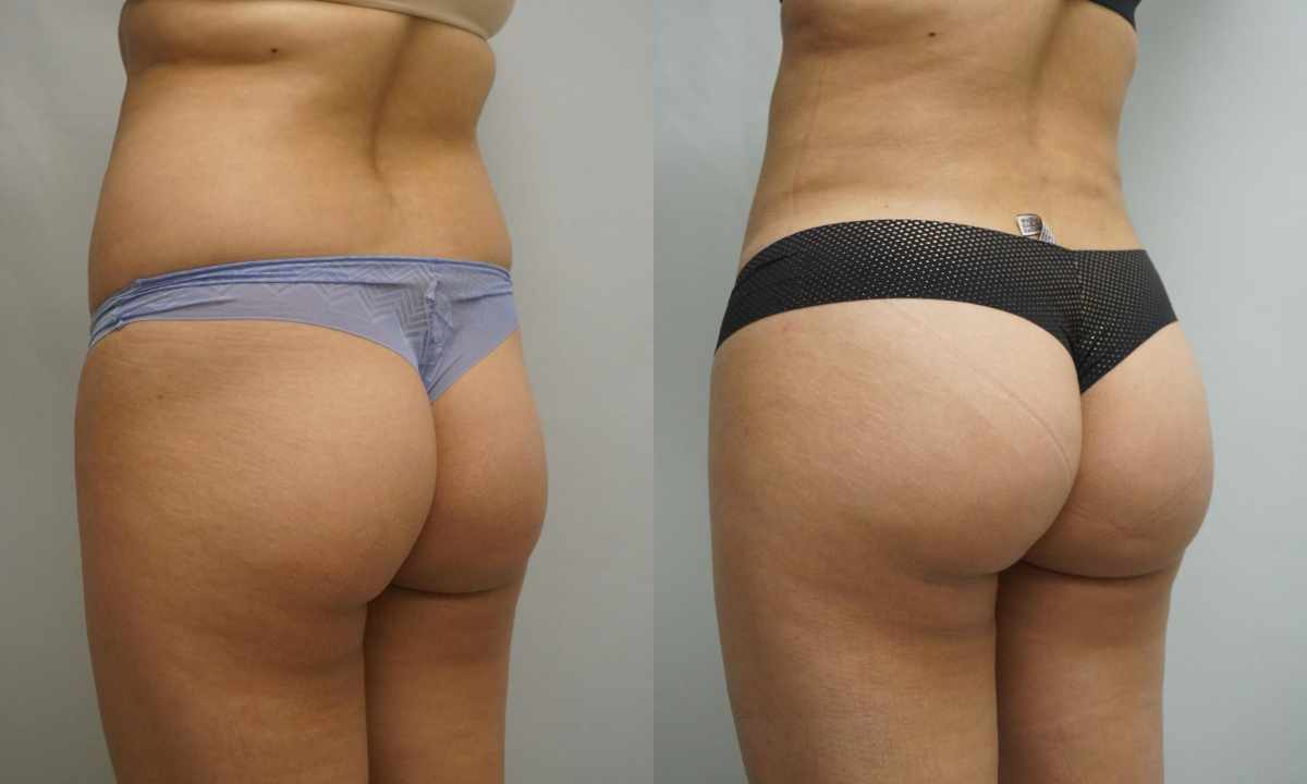 How quickly to reduce hips and buttocks