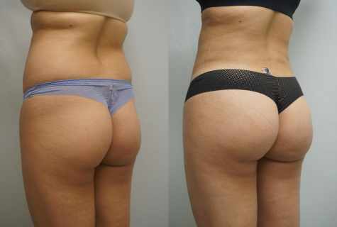 How quickly to reduce hips and buttocks
