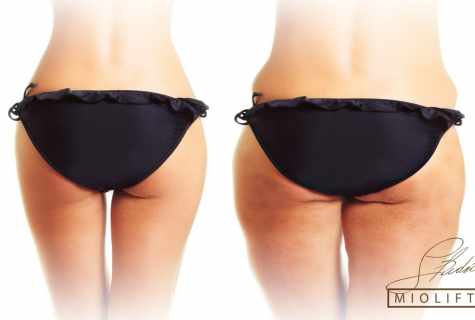 How to remove fat from buttocks