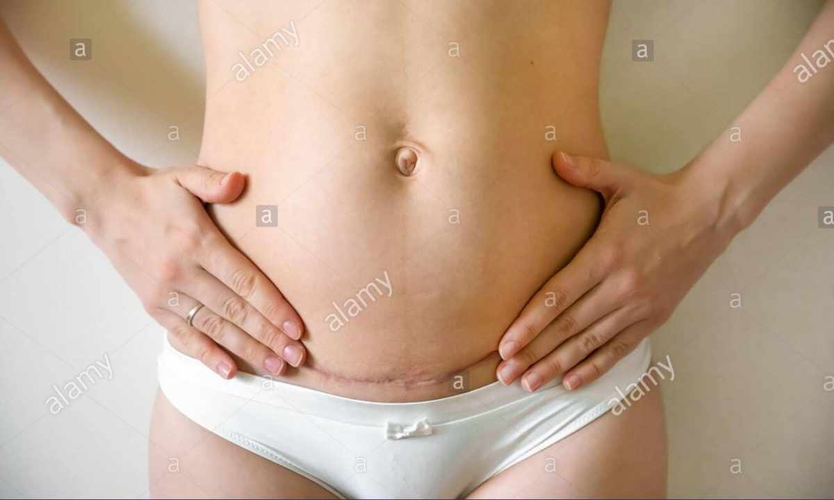 How to gather in the stomach after Cesarean section