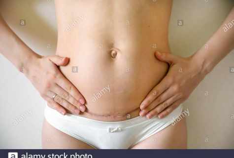 How to gather in the stomach after Cesarean section