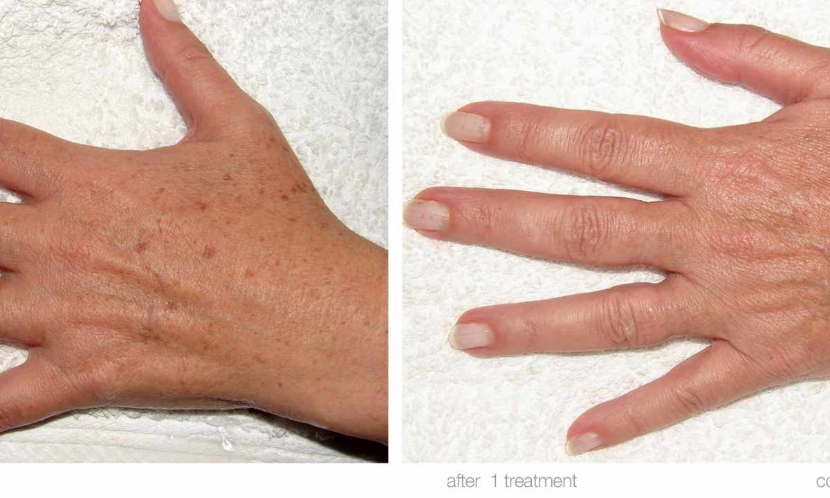 How to remove spots on hands