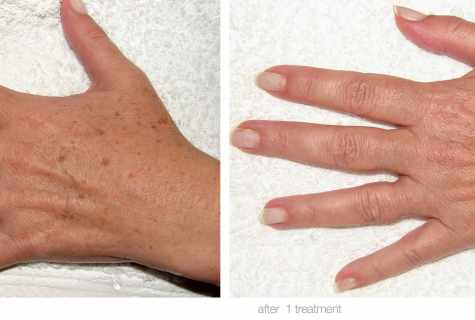 How to remove spots on hands