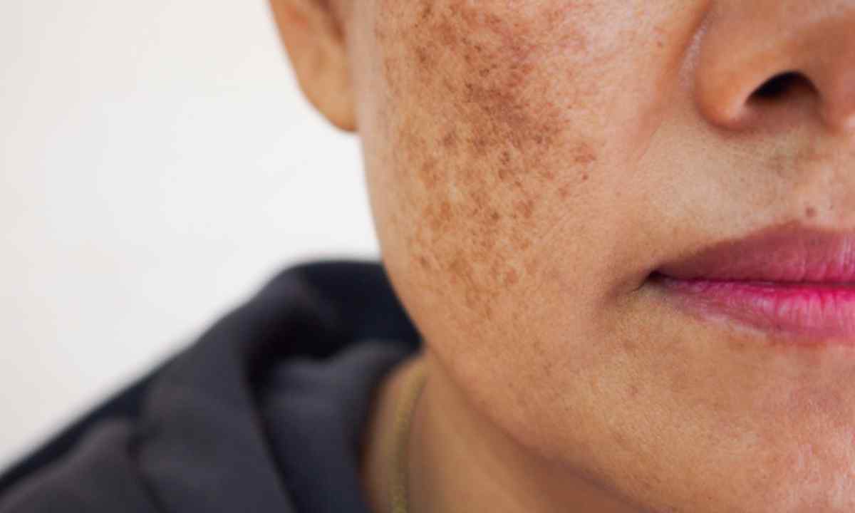 How to remove old spots