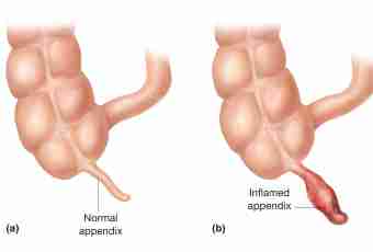 How to define appendicitis at the child