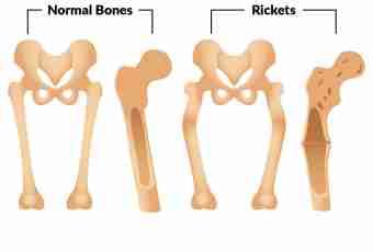 How to define rickets at the child