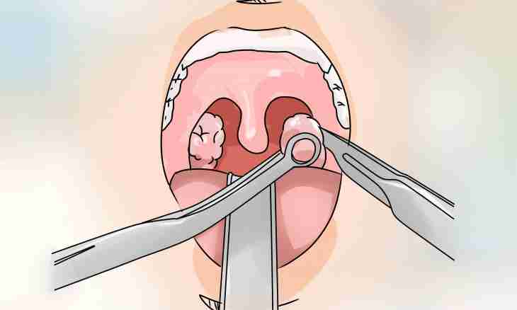 How to treat tonsillitis at children