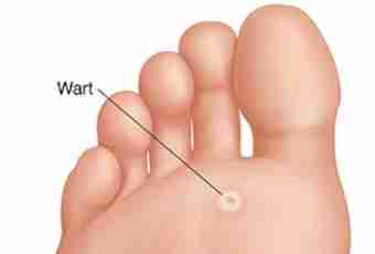 How to treat warts at children
