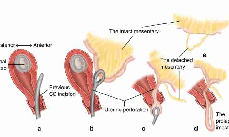 How to avoid a uterus tone
