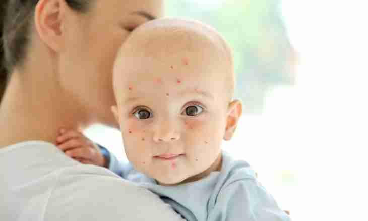 Symptoms of chickenpox at the child