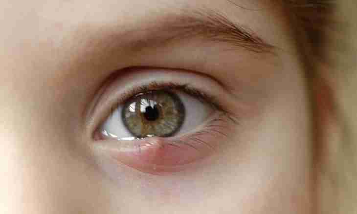 What to do if at the child eyes swelled up